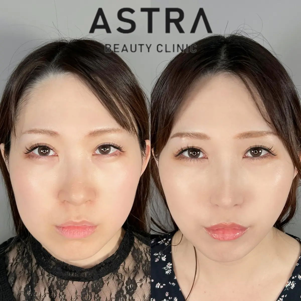 エラボトックスで小顔に大変身！shorts