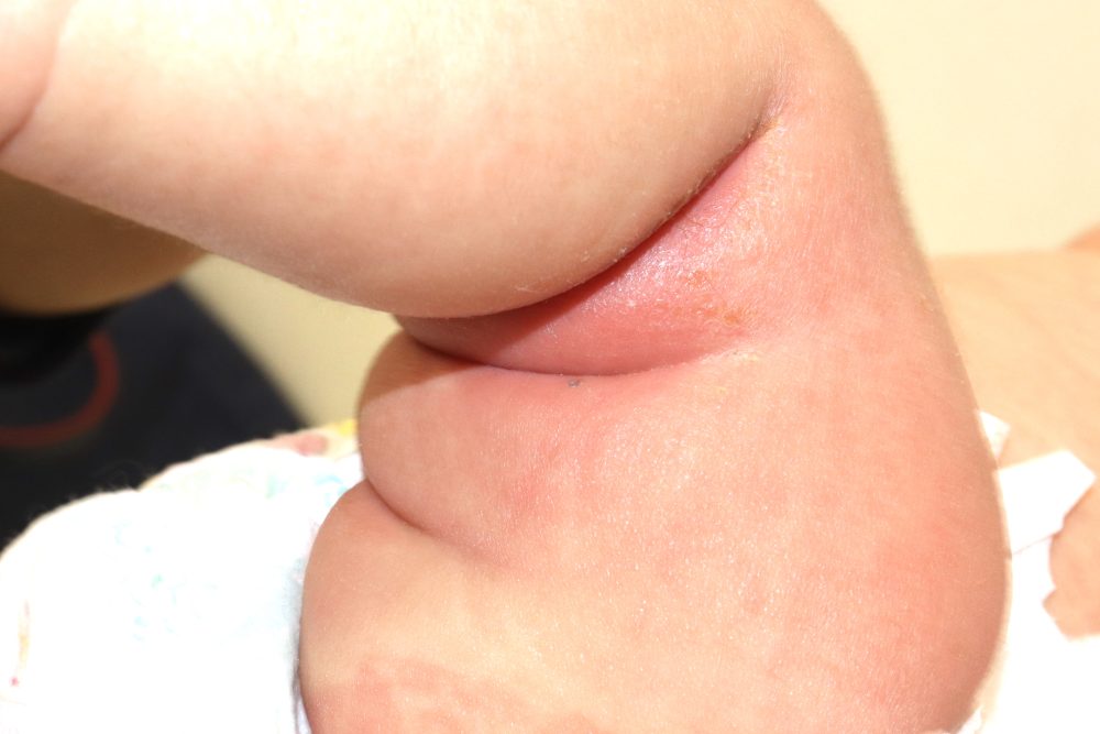 夏はあせもにご用心 - 医療トピックス中野区医師会