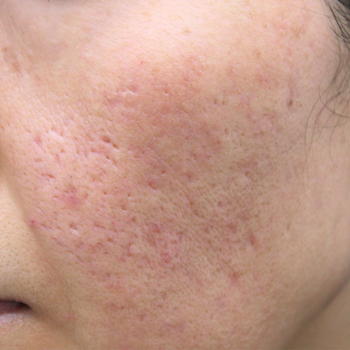 ニキビ治療 皮膚科と美容皮膚科のちがいは？ │ シェリークリニックニキビ治療に関するコラム