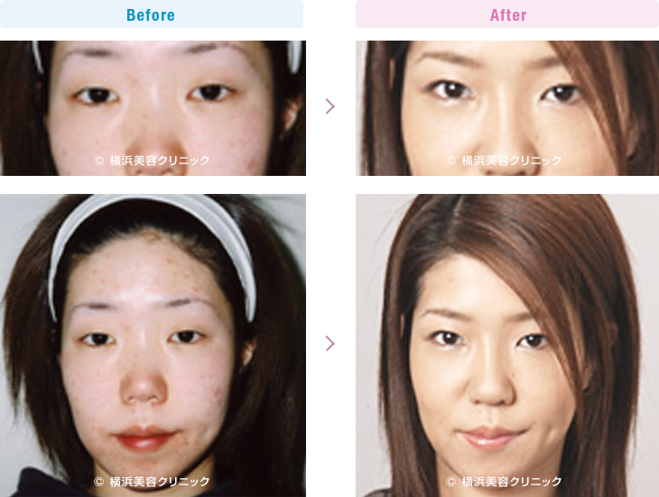 埋没法 + 脱脂MS法 -目 眼瞼 美容整形のリッツ美容外科