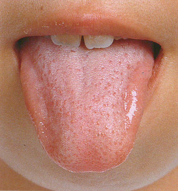 地図状舌口腔病理基本画像アトラス