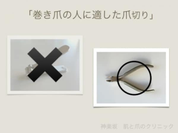 巻き爪切り方・ニッパー使い方を画像で解説大田区大森・大木皮膚科