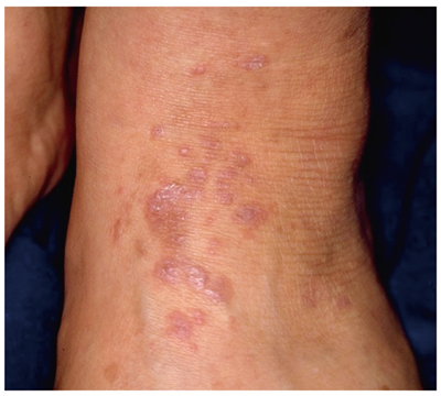 扁平苔癬 - 基礎知識 症状・原因・治療などMEDLEY メドレー