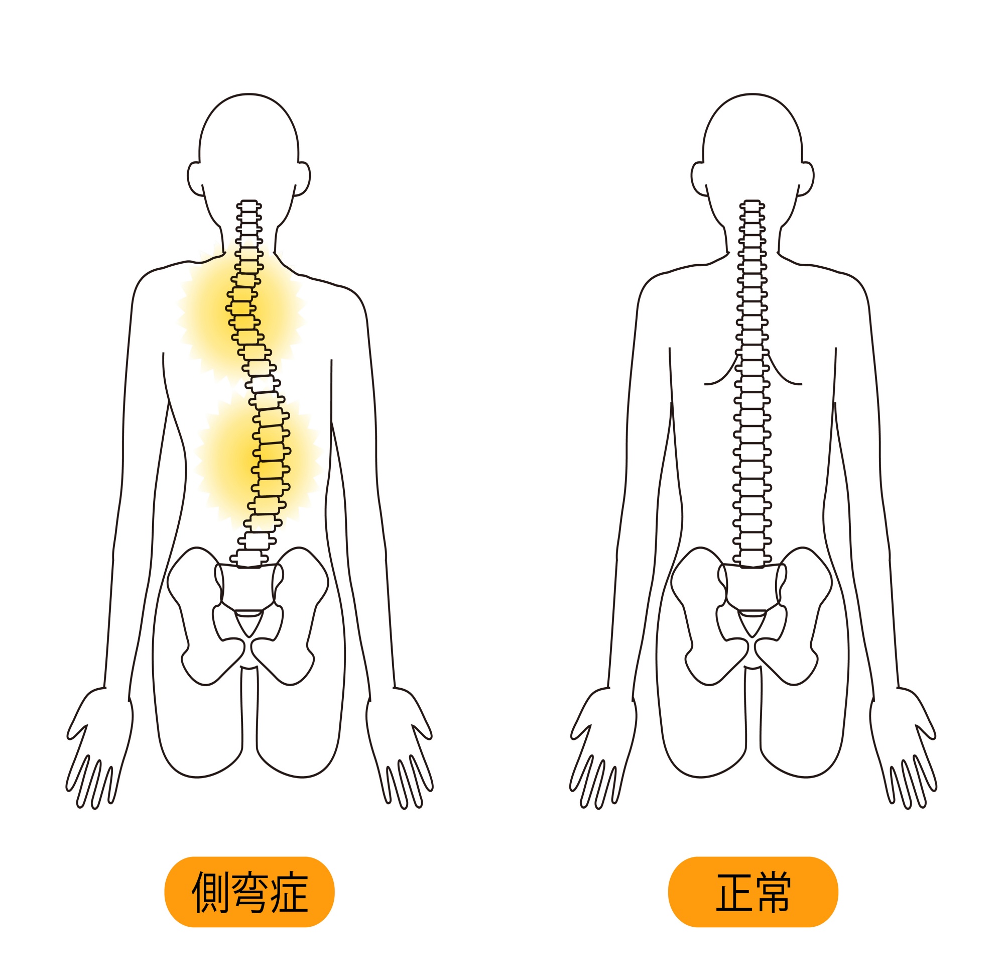 脊柱側弯症新中野整形・リハビリテーションクリニック 整形外科 リハビリテーション科 新中野 中野富士見町 中野区