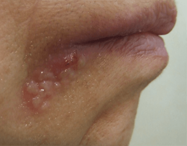 唇のできもの 白いブツブツやザラザラの原因は? 症状別に解説 医師監修- SillHa.com - 歯と口と身体の健康メディア -シルハドットコム- SillHa.com - 歯と口と身体の健康メディア -シルハドットコム