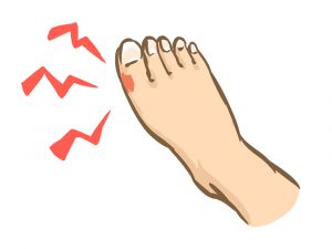 掌蹠膿疱症とは掌蹠膿疱症コミュニティのサイト