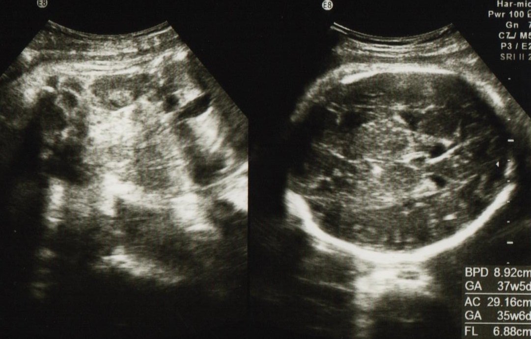 足のしびれを伴う逆子３４週目の妊婦さん逆子 骨盤位 ・横位のツボツボネット 鍼灸の症例が検索できるツボ辞典