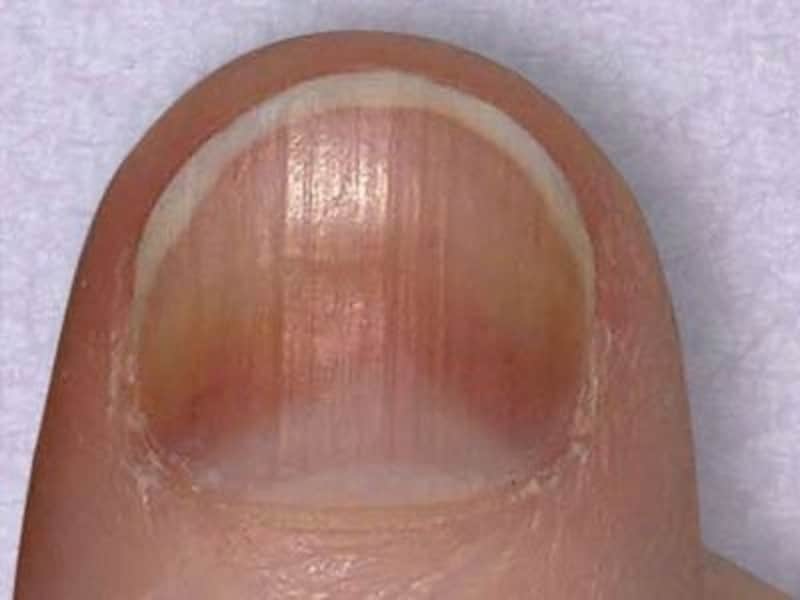 爪が緑色になってしまうグリーンネイルとは原因と治し方 – 所沢市の巻き爪治療矯正専門 埼玉巻き爪矯正院 所沢院