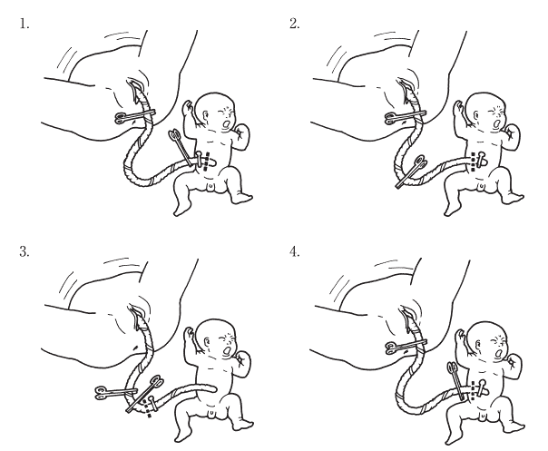 臍帯トラブル へその緒の異常が脳性麻痺を引き起こす可能性産科医療過誤 解決への安心読本