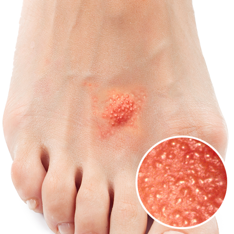 靴擦れにも役立つ！ハイドロコロイド – もものマークのほけんしつ