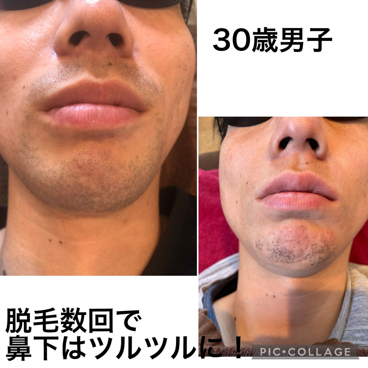 HEROのひげ脱毛福岡市中央区大名のメンズ脱毛・フェイシャルエステHERO