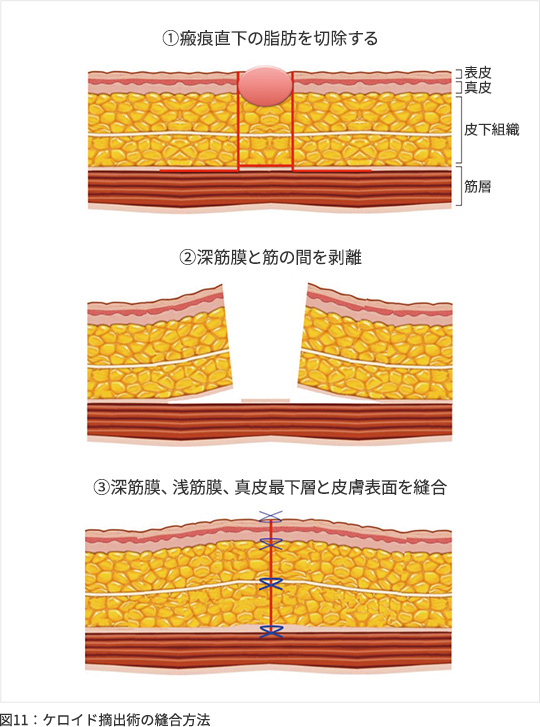 築地皮膚と手のクリニック » 手術手技：縫う
