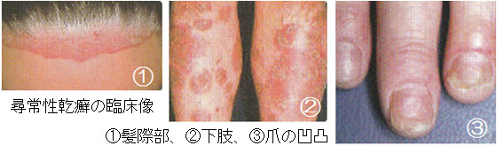 乾癬について 17乾癬の病型2-滴状乾癬医療法人翠真会 のえ皮フ科クリニック