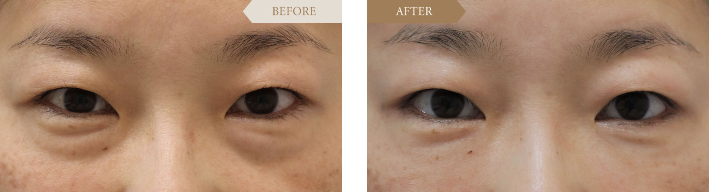 寝不足とクマの関係原因と見分け方・解消法について