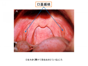 扁桃炎 「喉が痛い！扁桃腺が腫れてる！」 のどに白いウミにしおぎ耳鼻咽喉科クリニック 公式