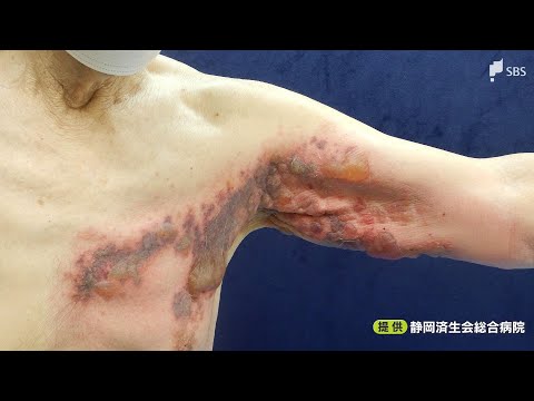 佐々木整形外科治療例 帯状疱疹による腰痛、股関節周囲の痛み56歳 女性