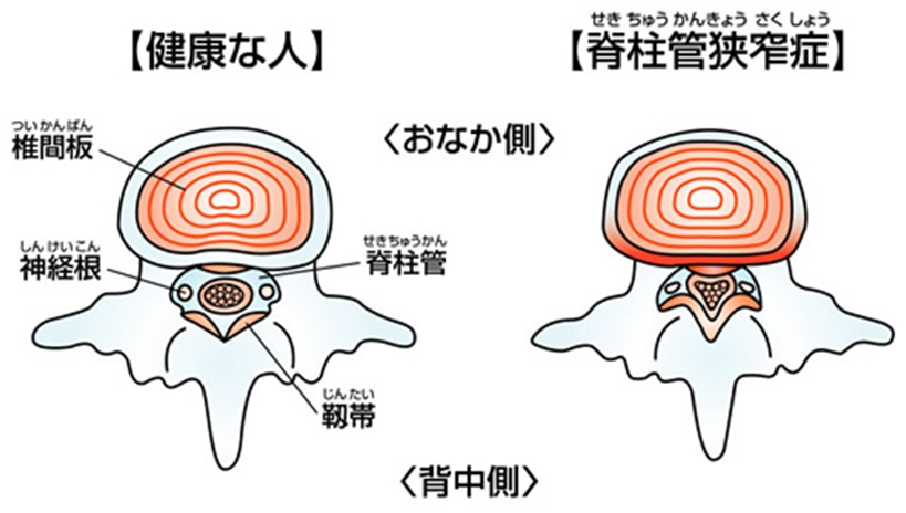 腰部脊柱管狭窄症についてまとめました✍️腰部脊柱管狭窄症看護看護学生看護学生の勉強垢勉強垢看護師国家試験看護師国家試験対策第112回看護師国家試験看護学生のノートまとめノートまとめレビューブックレビューブック太っちょ計画