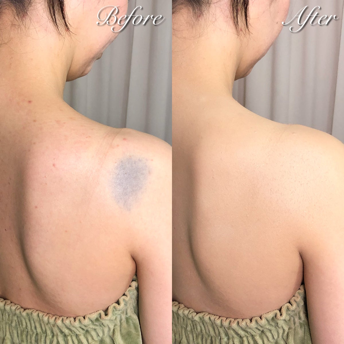 生まれたときから背中に色の濃いあざが２つ。「自然には消えない」と言われ、レーザー治療を決意 異所性蒙古斑・体験談 たまひよ