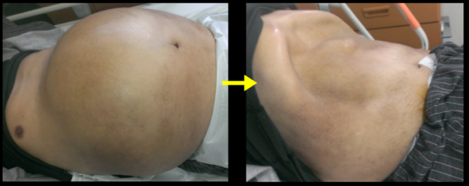 医師監修 アルコール性肝障害でよく見られる「腹水」の治療法とは？医師が作る医療情報メディア medicommi