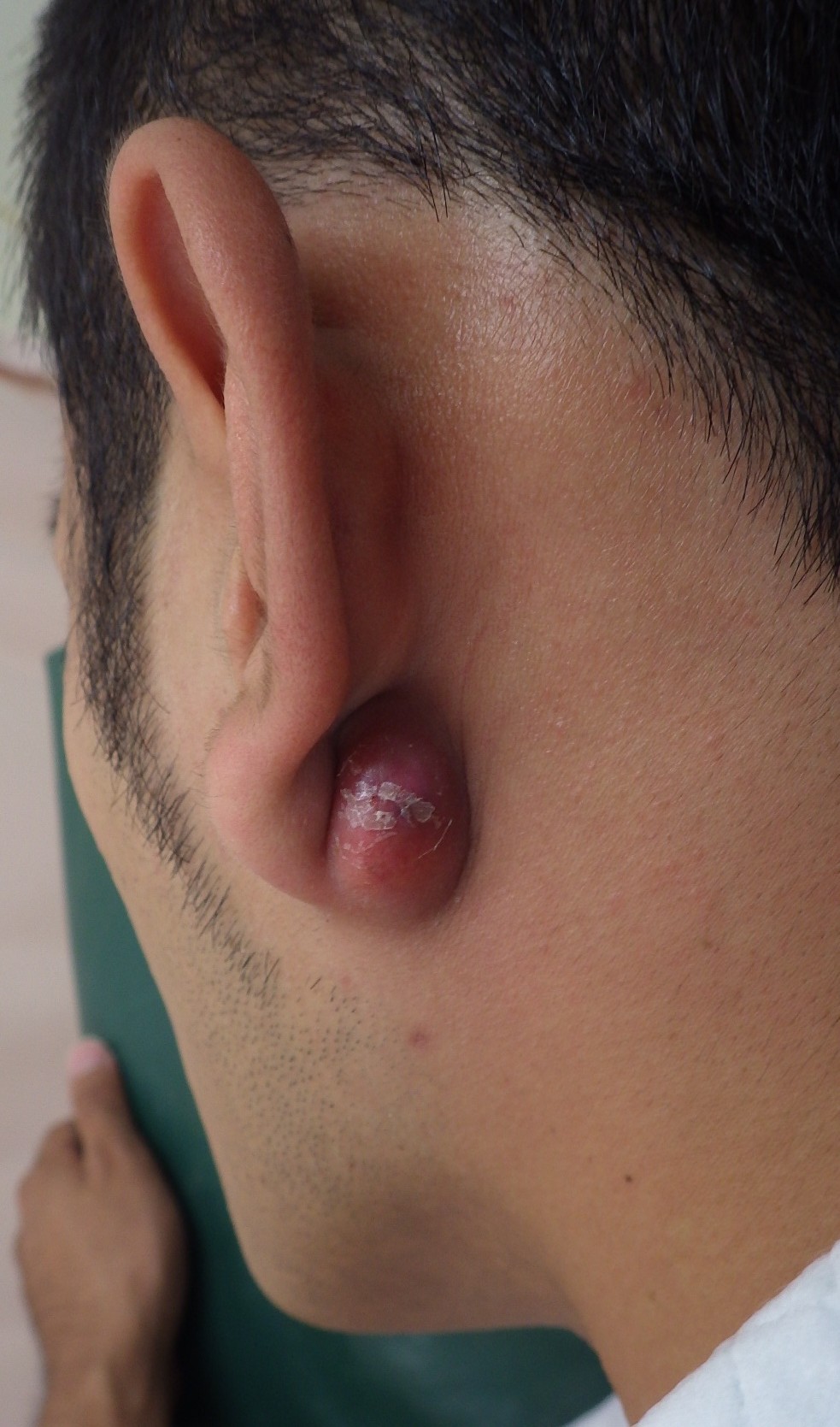 粉瘤 アテローム の症状と原因、治療海老名皮フ科クリニック