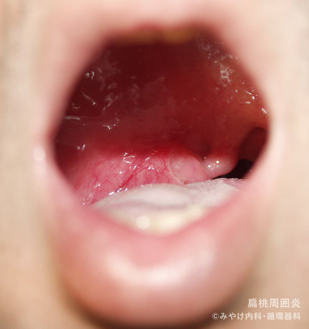 喉の痛みを引き起こす性感染症 男女 池袋マイケアヒルズタワークリニック