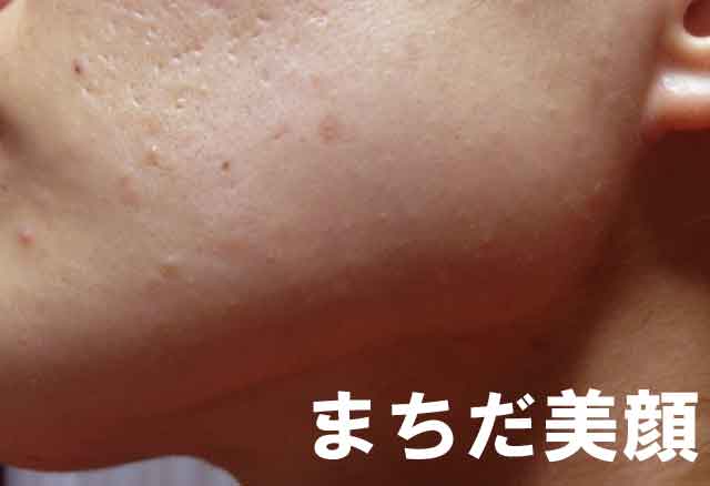 首ニキビが酷すぎます。おすすめの石鹸とか教えてください。ちなみ- Yahoo!知恵袋