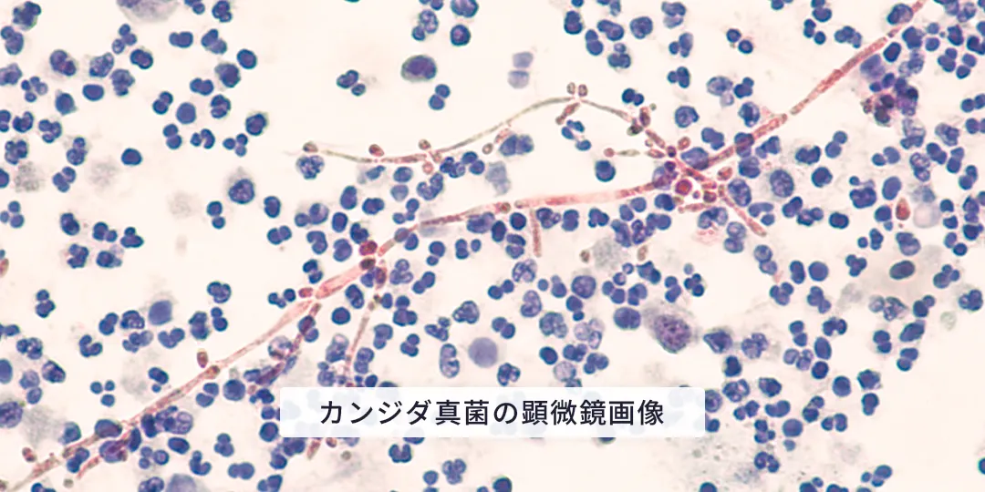 おりものが生臭い原因は細菌性腟症かも？細菌性腟症の症状・原因・治療法について徹底解説ネオクリニック