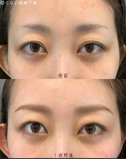 視力の左右差の許容範囲はどのくらい？主な症状や原因・治療方法を紹介先進会眼科コラム