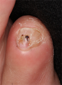 いぼ 軟性線維腫 ひびきの皮ふ科 北九州市八幡西区学研都市ひびきのにある皮膚科