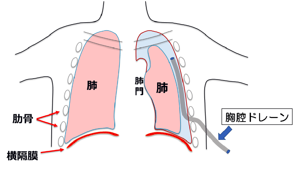 胸腔ドレナージ