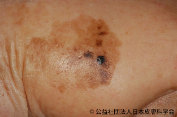 一般皮膚科 – 西三河の皮膚科・美容皮膚科あおい皮フ科クリニック肌・美容のお悩みに