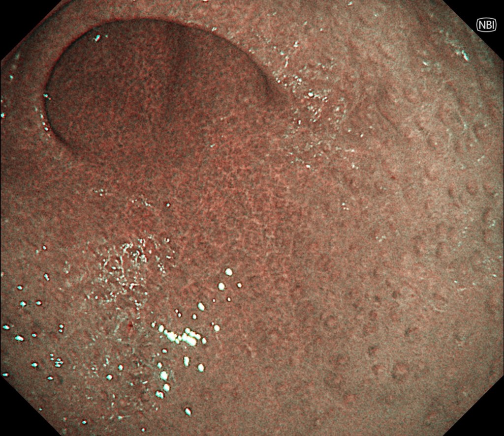 胃カメラでわかる病気内視鏡・堺 ましも内科・眼科クリニック 胃カメラ・大腸カメラ