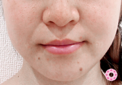 エラボトックス小顔注射 - 医療脱毛専門美容皮膚科レナトゥスクリニック