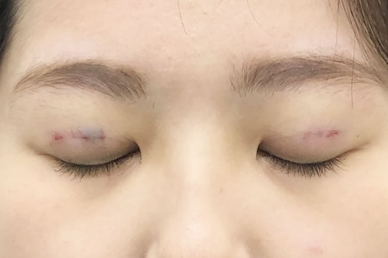 青あざができやすいのはなぜ？ぶつけていないのにできる原因や子どもの生まれつきの青あざも紹介