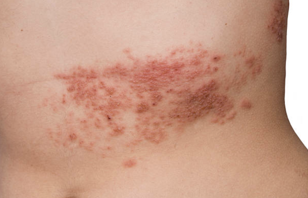 帯状疱疹ってなに？桜新町皮フ科クリニック