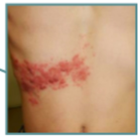 特集 帯状疱疹はすぐに治療し、後遺症を防ぐファーマスタイルWEB