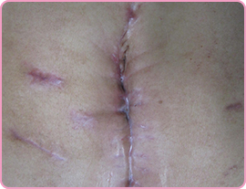 心臓弁膜症手術に対する小切開手術 ―小さな傷で社会復帰も速やかに！―心臓血管外科記事診療科・各部門土谷総合病院 広島市中区