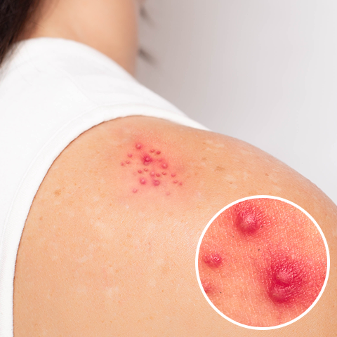 帯状疱疹？」鎖骨の赤い湿疹が日に日に悪化。実母の指摘で思い出した友人の地獄の痛み熟女系 94│40代50代女性のお悩み解決ウーマンカレンダ