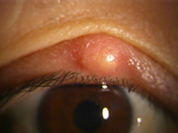 みやわき眼科 霰粒腫 - 尼崎市 緑内障 日帰り白内障手術