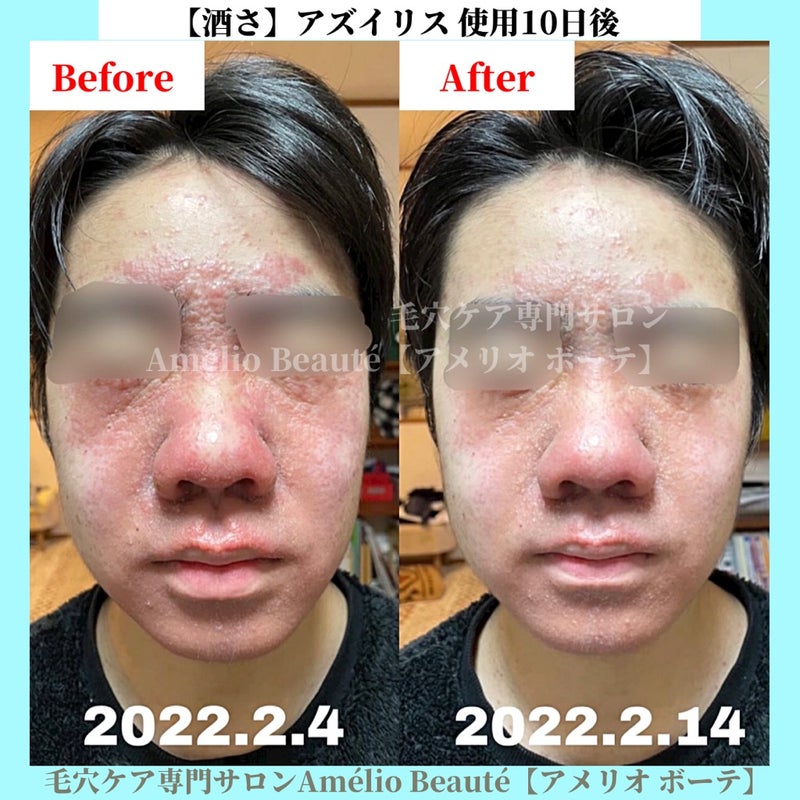 小鼻周りのボコボコ 角栓 - 画像のように小鼻周りがボコボコ Q&A - @cosme アットコスメ