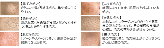 たるみ毛穴」「帯状毛穴」治療美容皮膚科 銀座よしえクリニック 公式 東京