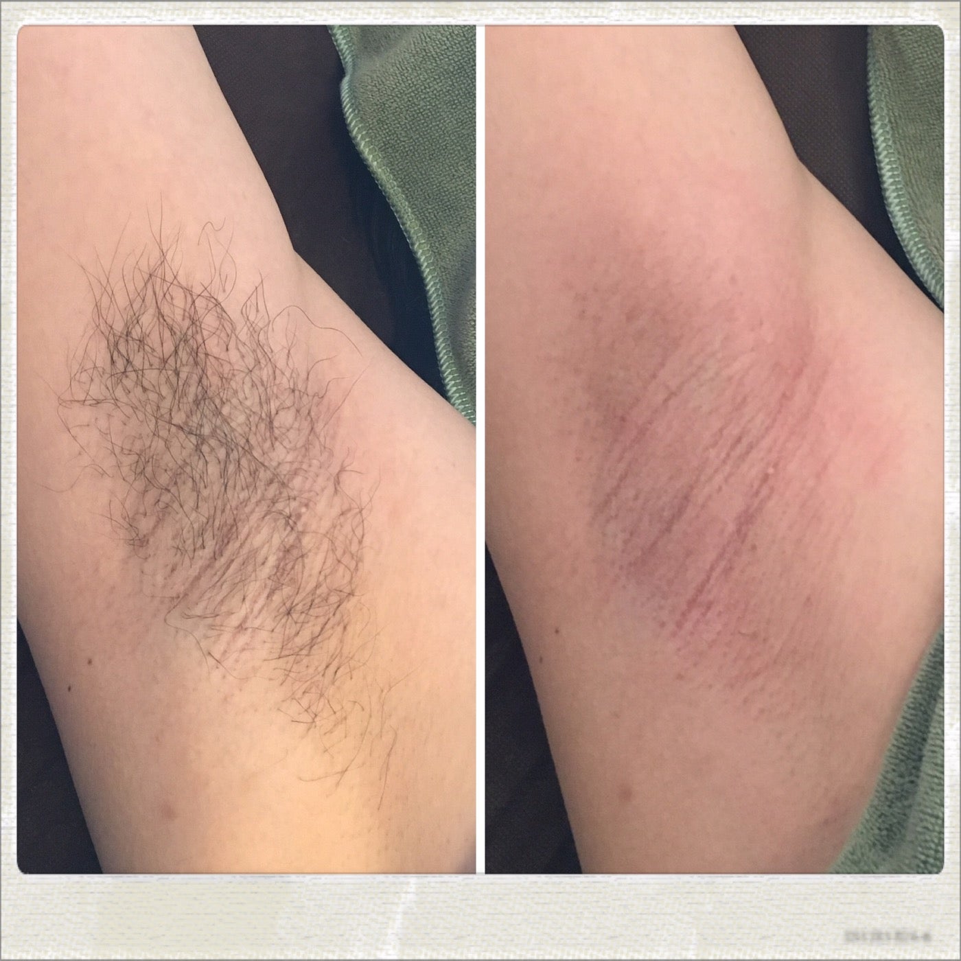 女性の脇の脱毛前の剃毛アップの写真素材199066844 毎月1点無料 フリー のストックフォト イメージマート