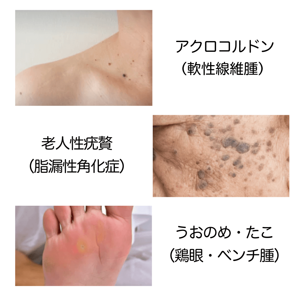 イボ 尋常性疣贅FUSION CLINIC