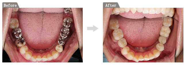 複数の歯がない「多数歯欠損」の状態からのインプラント・ブリッジによる治療方法新橋歯科医科診療所 痛くない削らない歯医者
