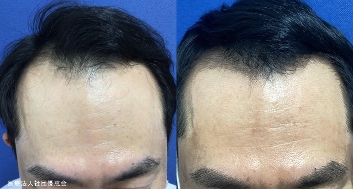 次世代のAGA治療！ 自身の幹細胞を用いた毛髪再生医療とはGOETHE