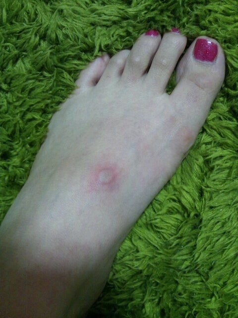 手足のかゆみがつらい！小さな水ぶくれができる原因と治療法を解説 イシャチョク