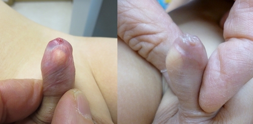 その他の皮膚のできものの症状 治療方法について - 渋谷駅前おおしま皮膚科 形成外科