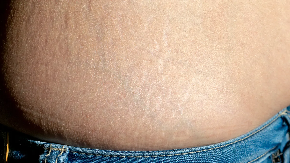 豊胸で肉割れが起きる？対処方法は？公式コラム美容整形・二重整形なら共立美容外科