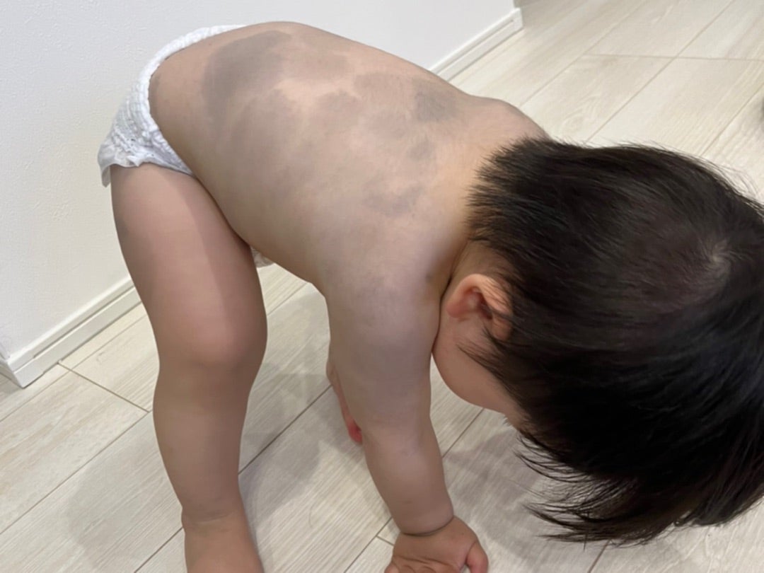 アザ 太田母斑・蒙古斑・扁平母斑診療案内共立美容外科宇都宮院 栃木県宇都宮市の美容外科・美容皮膚科 美容整形