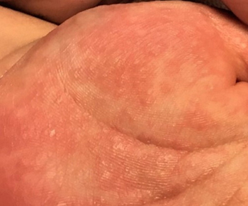 皮膚がんの早期発見別府医療センタ